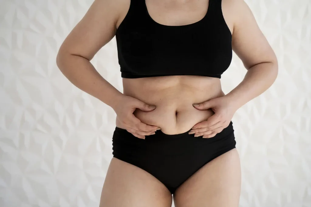 Belly before gastric balloon surgery