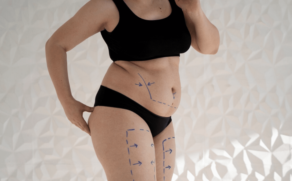 Liposuction in Turkey and pre surgery