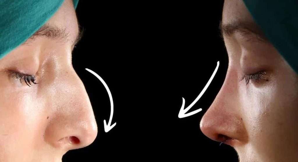 Rhinoplasty surgery in Turkey before and after images