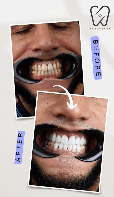 before and after dentist in turkey