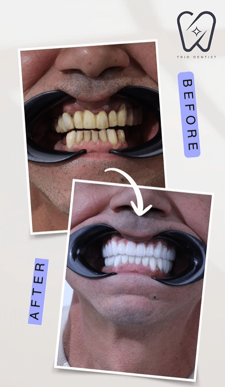 before and after teeth whitening in turkey