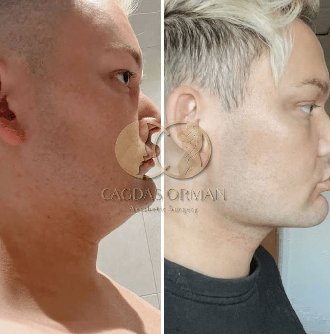 before and after javline
